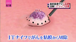 癌 手術 高額医療