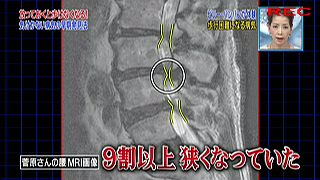 腰部脊椎管狭窄症